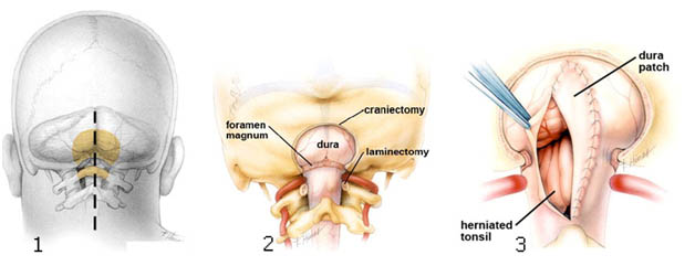 http://syringomyelia.ru/images/stories/pict/1%2021.jpg